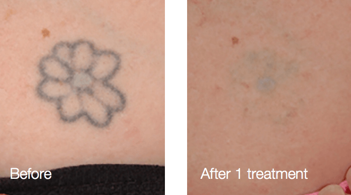 Tattoo Removal Archives  Removery