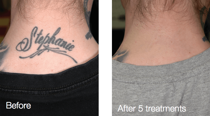Los Angeles Tattoo Removal  Laser Tattoo Removal in Los Angeles