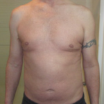 Testosterone Replacement Therapy Before & After Patient #289