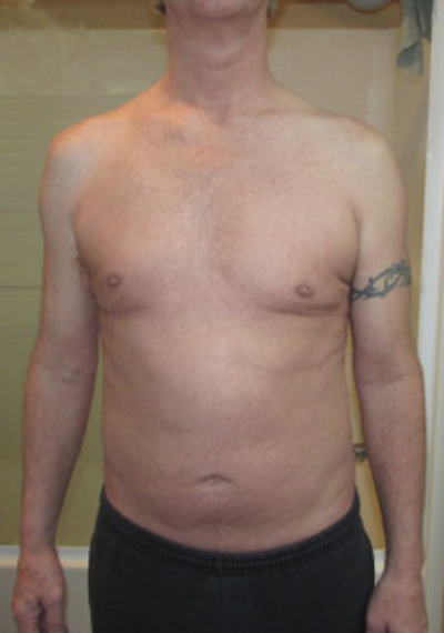Testosterone Replacement Therapy Before & After Patient #289